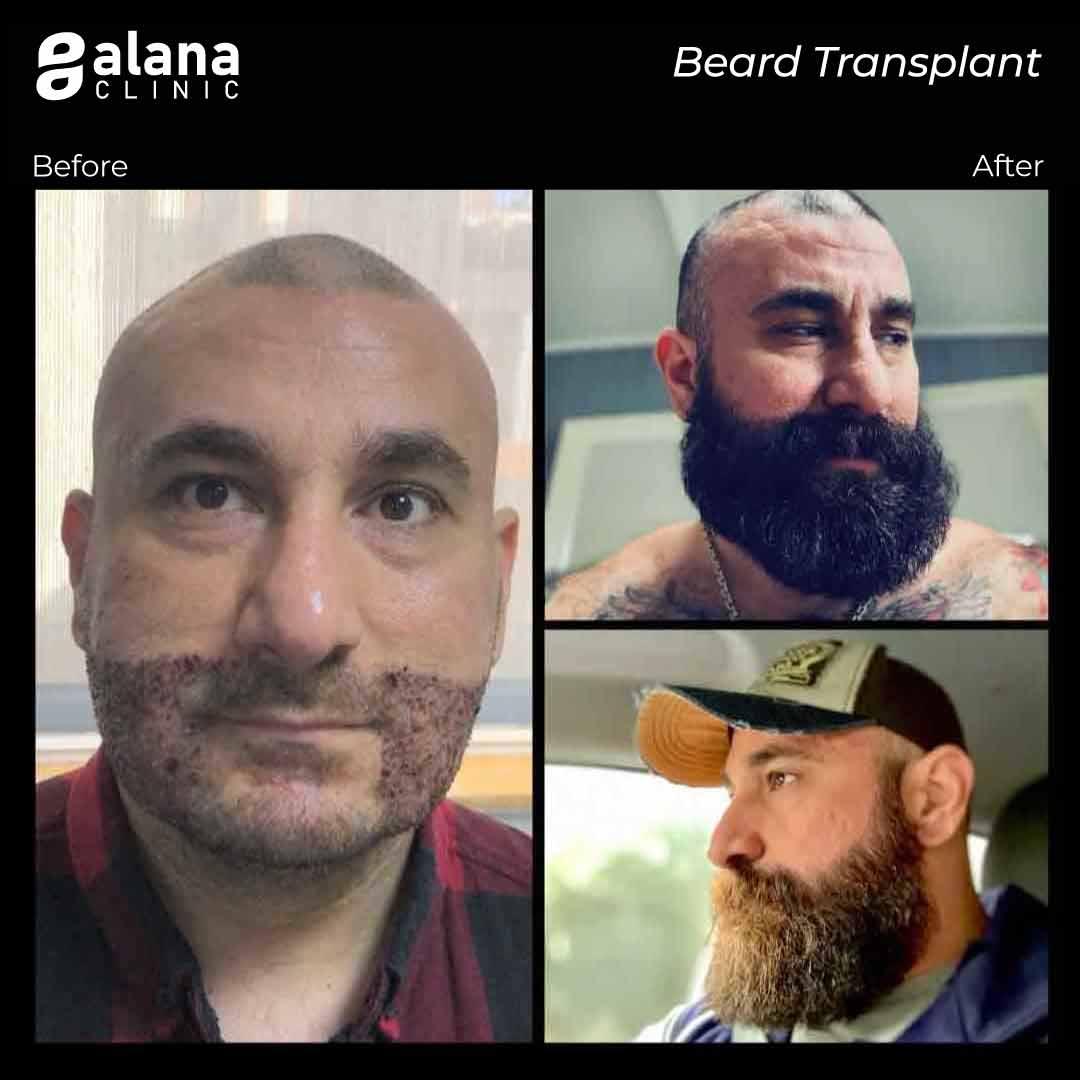 Beard Transplant Alana Hair Clinic