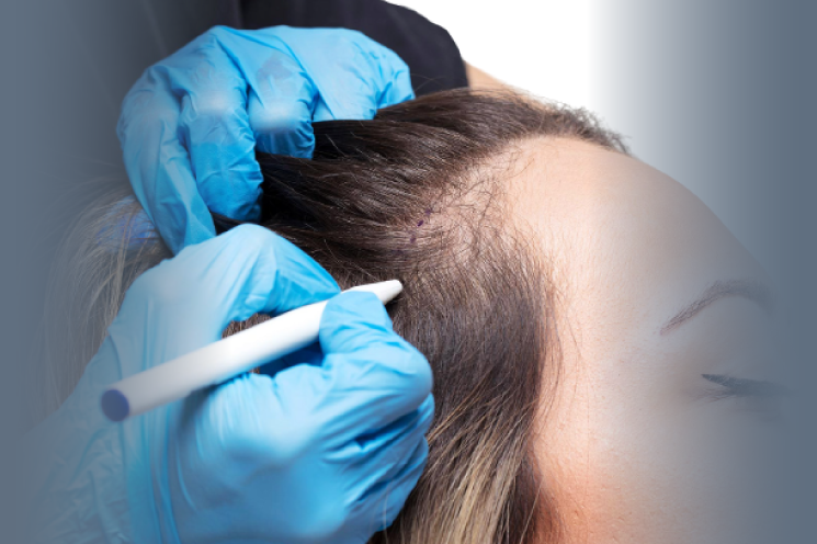 hair transplant sld