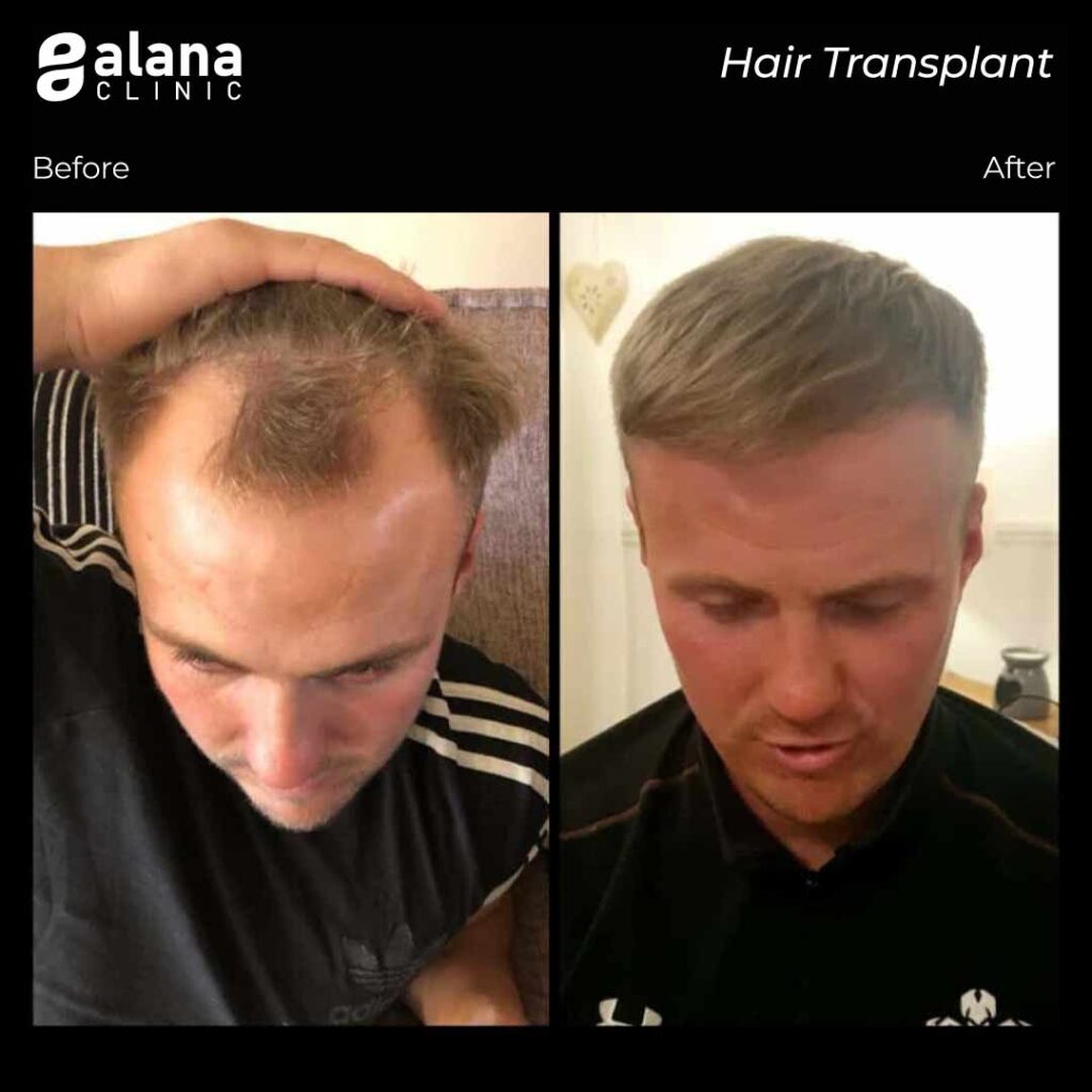 Hair Transplant Turkey Before After - Results - Alana Hair Clinic