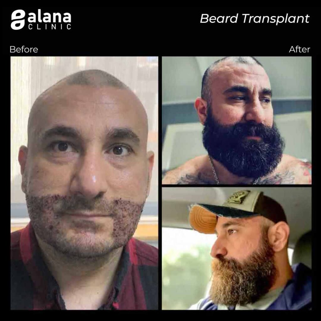 beard transplant Turkey before and after
