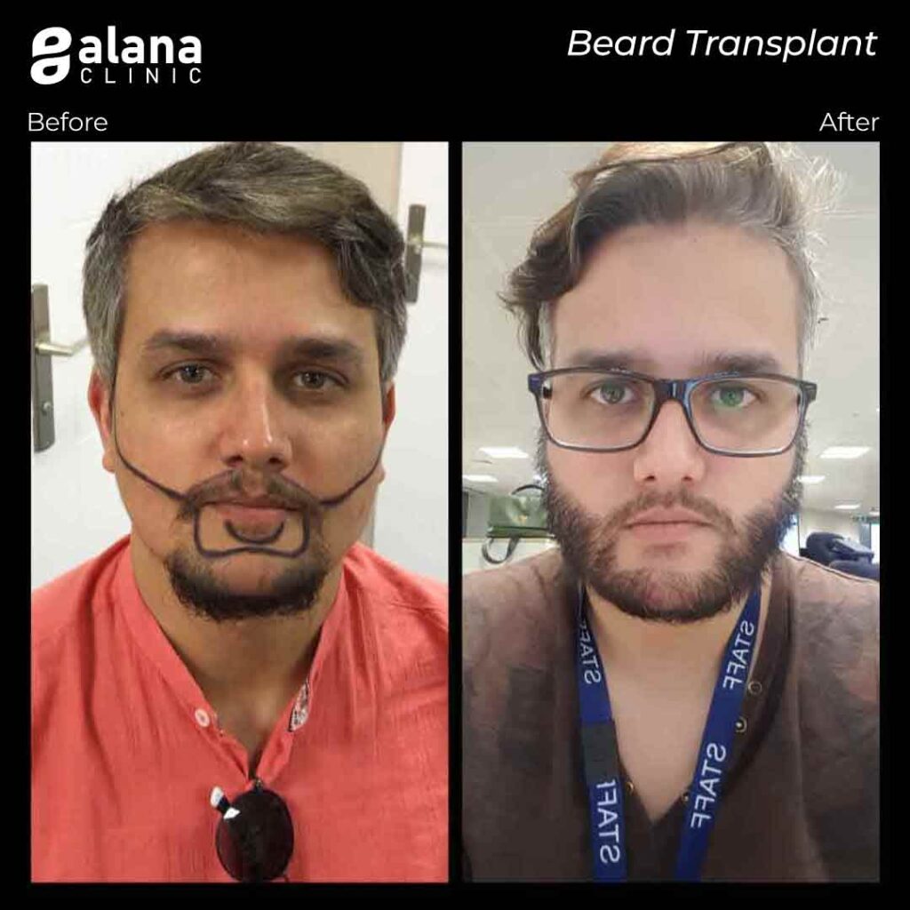 before and after beard transplant turkey