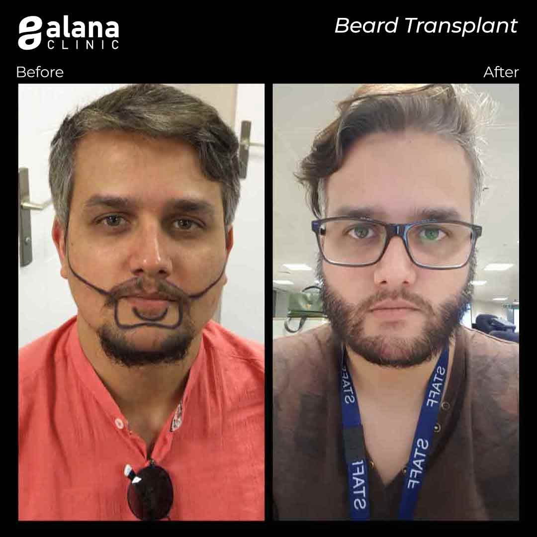 Beard Transplant Alana Hair Clinic