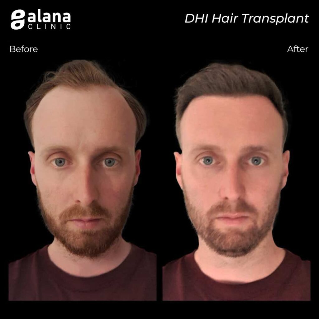 DHI Hair Transplant Turkey - Alana Hair Clinic