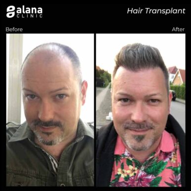 hair transplant turkey before and after