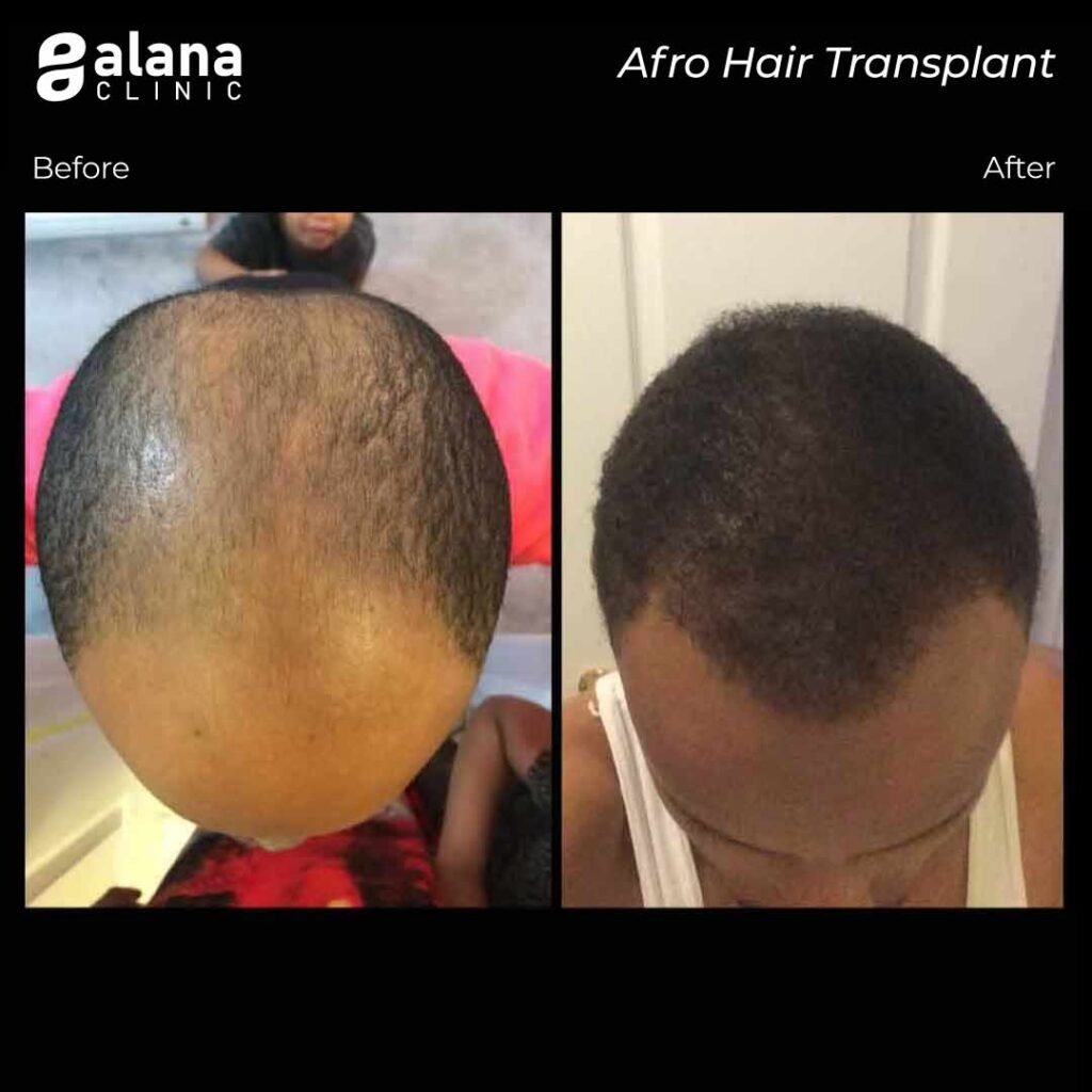 Afro Hair Transplant Turkey - Alana Hair Clinic