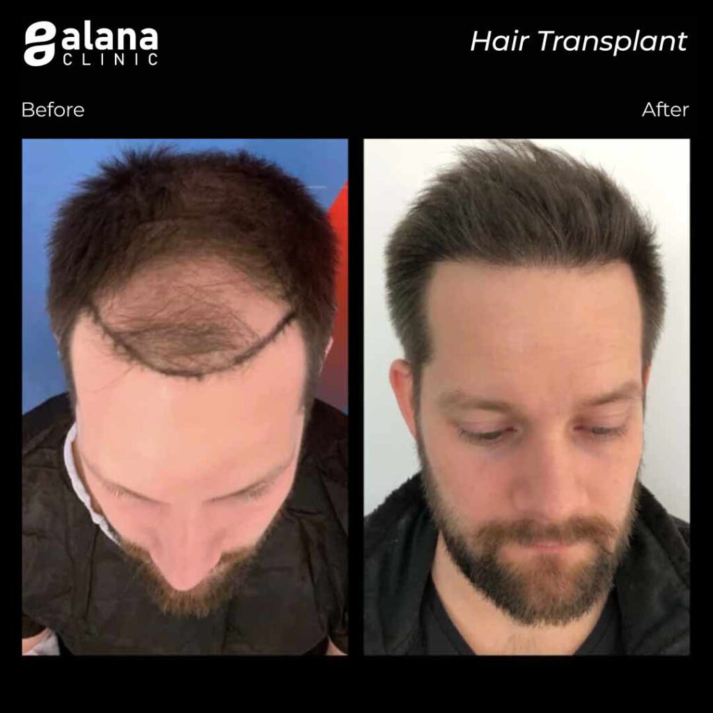 Before and after hair transplant Turkey