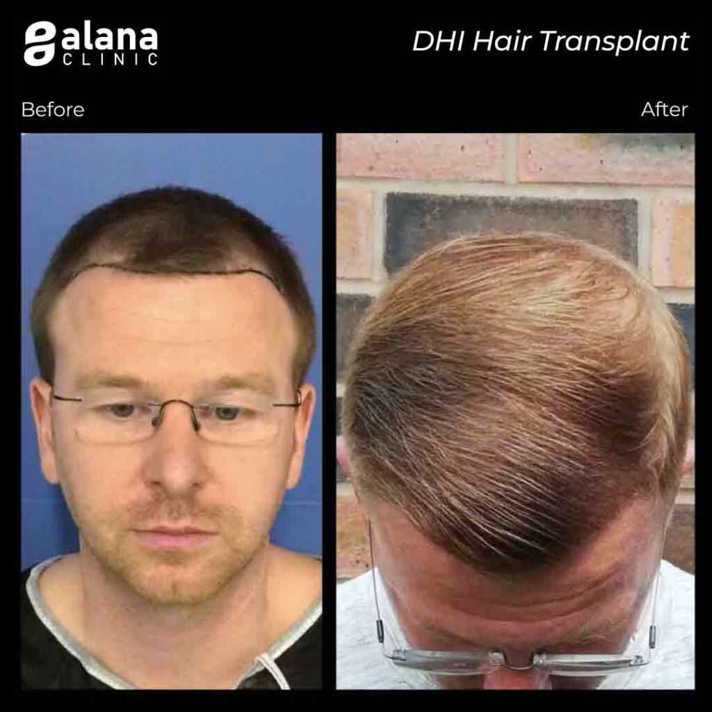 before after Dhi hair transplant turkey