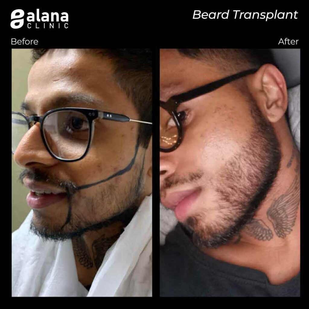 trasplante de barba en turquia 1