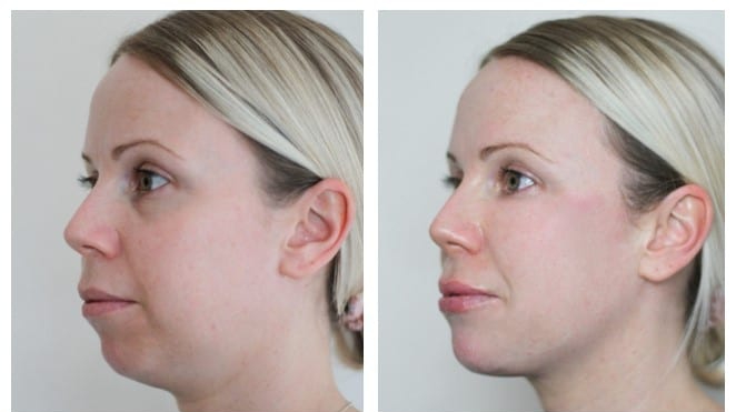 dermal fillers full face rejuvenation before after