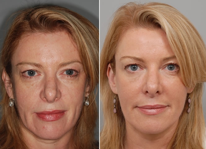 hydrafacial before after