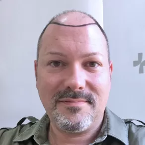 Greffe de Cheveux Avant et Après MORTEN BEFORE