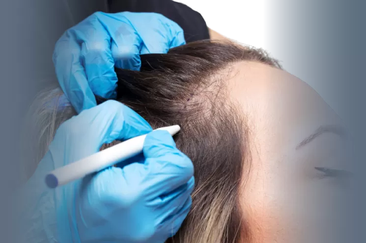Greffe de Cheveux pour Femmes en Turquie hair transplant sld