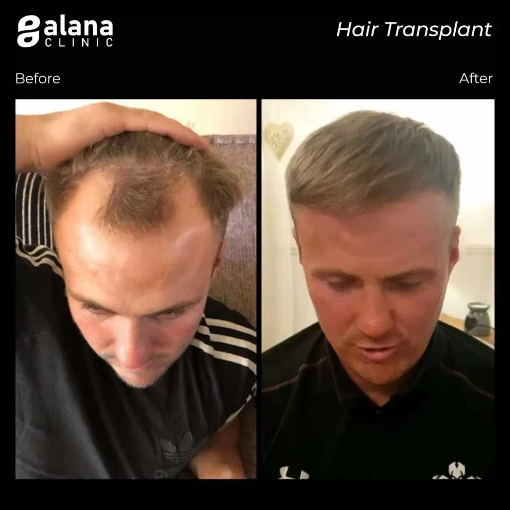Greffe de Cheveux Avant et Après 3500 grafts hair transplant turkey