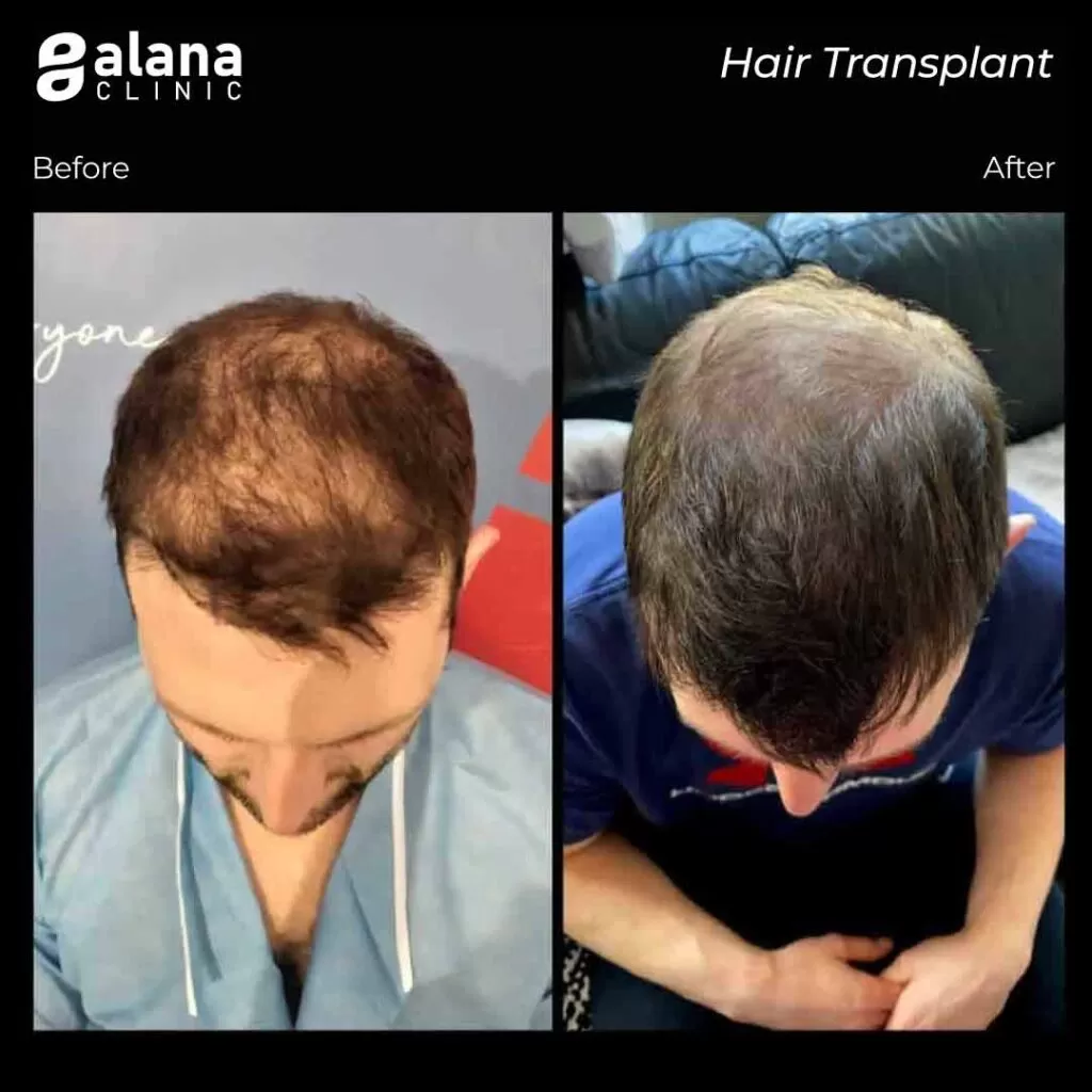 Greffe de Cheveux Avant et Après FUE hair transplant Turkey Alana Clinic