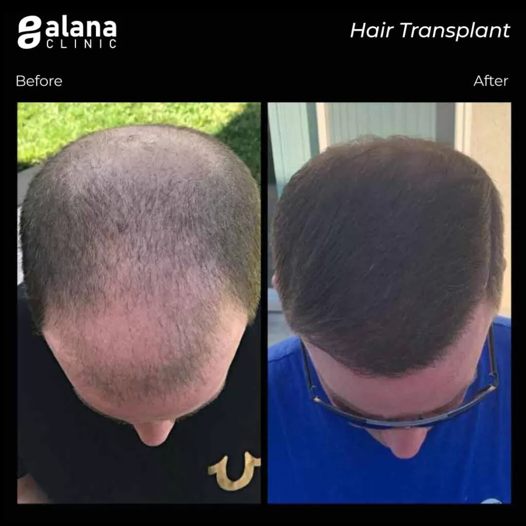 Greffe de Cheveux Avant et Après FUE Hair Transplant before and after