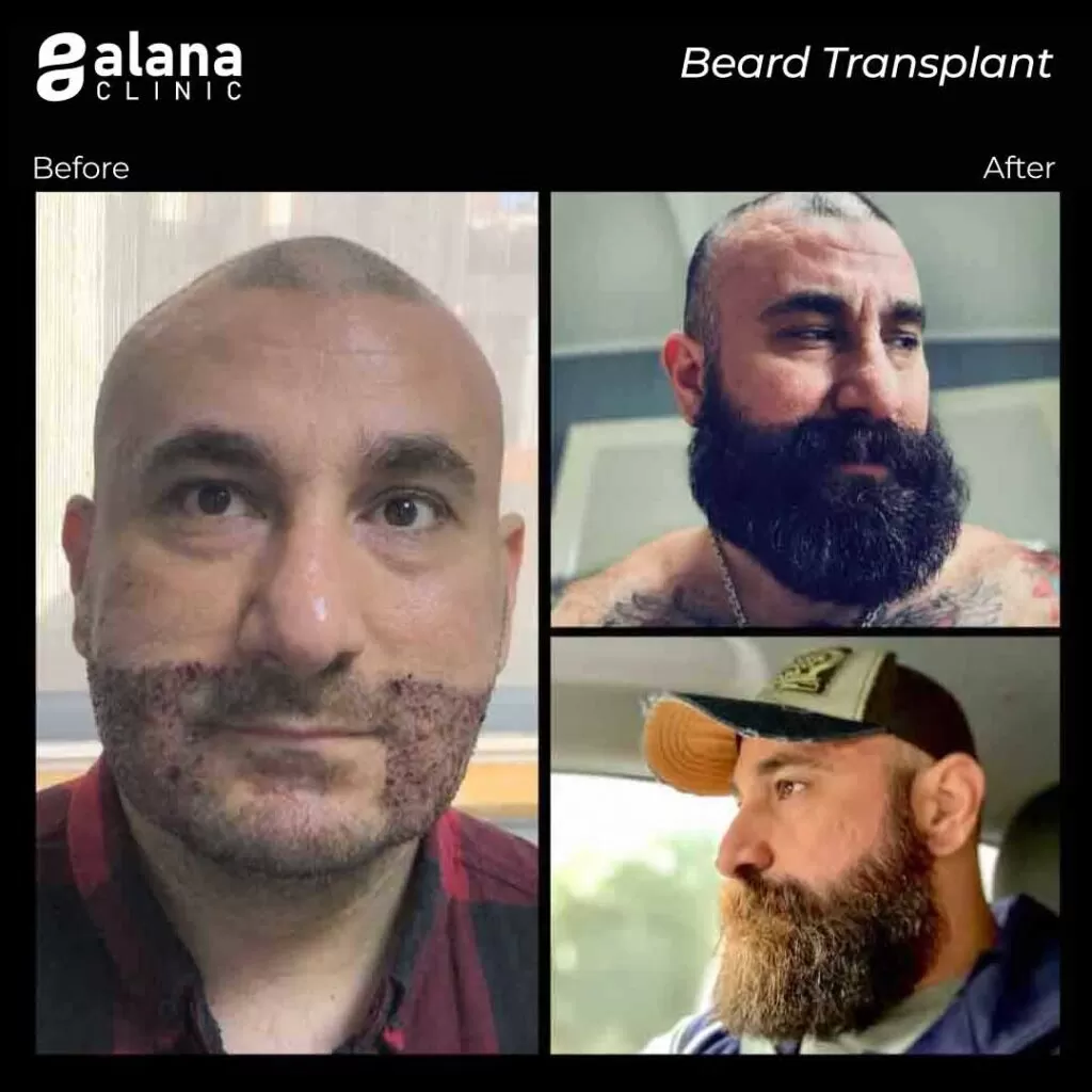 Greffe de Cheveux Avant et Après beard transplant Turkey before and after