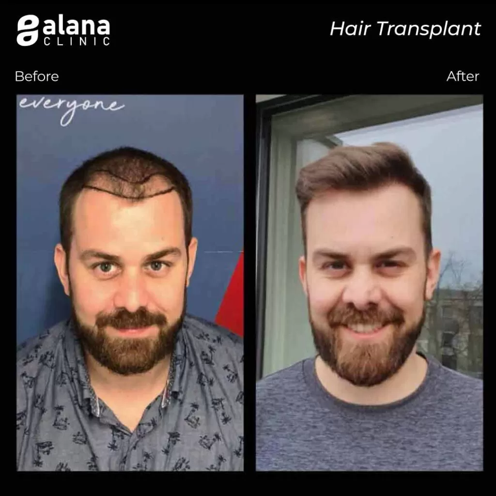 Greffe de Cheveux Avant et Après hair transplant Turkey