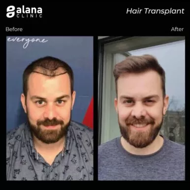 hair transplant Turkey