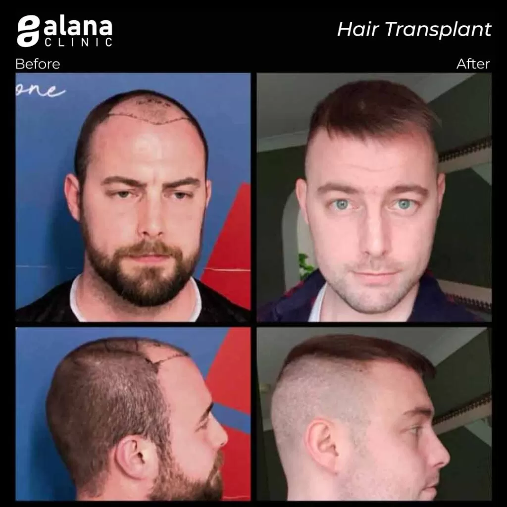 Greffe de Cheveux Avant et Après 3300 grafts-hair transplant Turkey