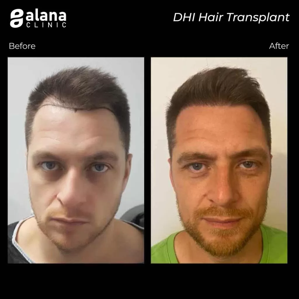 Greffe de Cheveux Avant et Après before and after dhi hair transplant Turkey