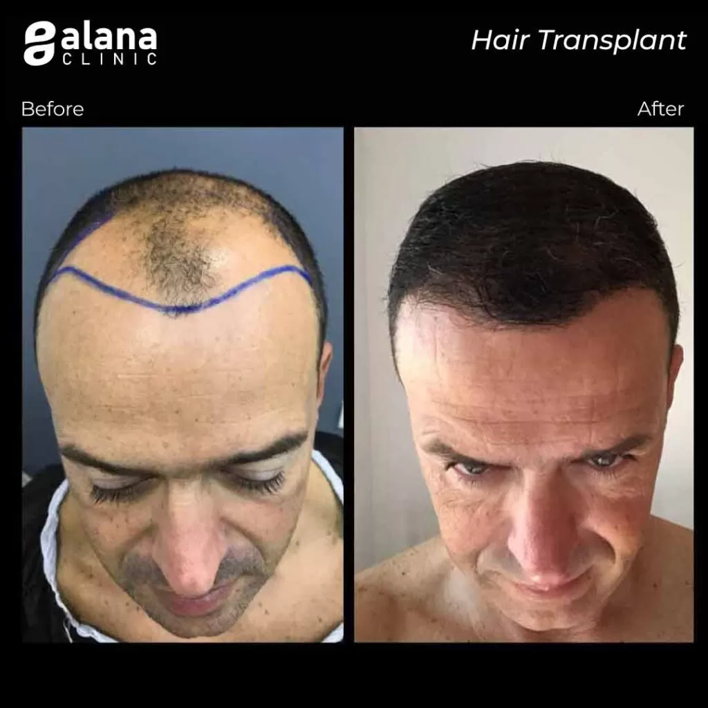 Greffe de Cheveux Avant et Après FUE hair Transplant Turkey Alana Clinic