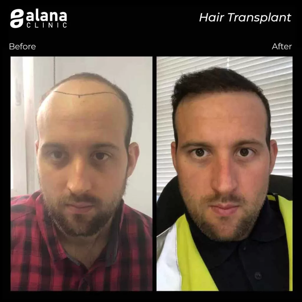 Greffe de Cheveux Avant et Après Alana Clinic before and after hair transplant