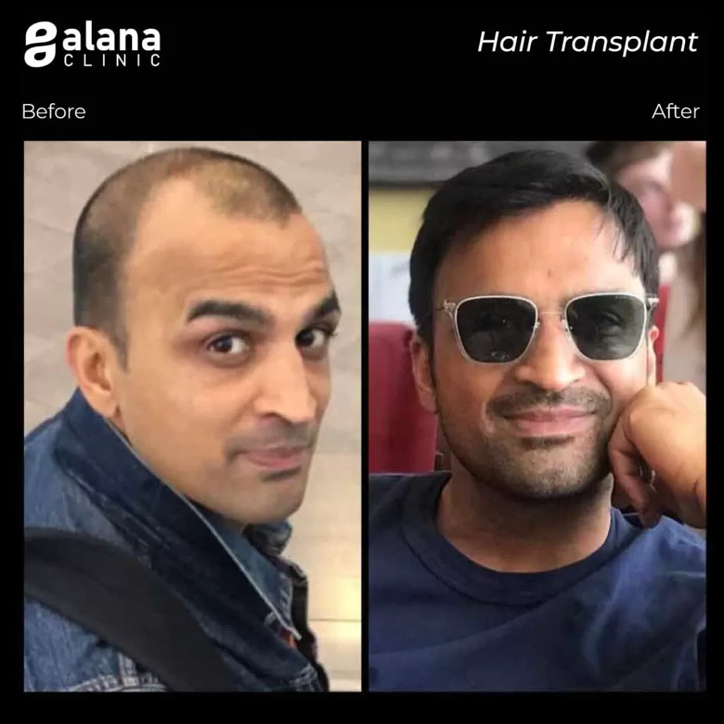 Greffe de Cheveux Avant et Après 3750 Grafts hair transplant Turkey