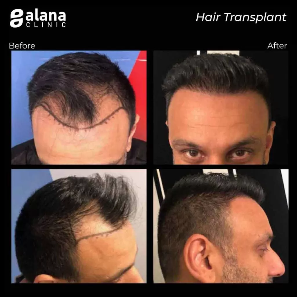 Greffe de Cheveux Avant et Après 2800 grafts- hair transplant Turkey