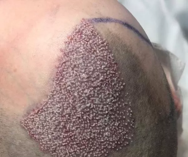 DHI-Hair-Transplant-Turkey-imf Nuria Test
